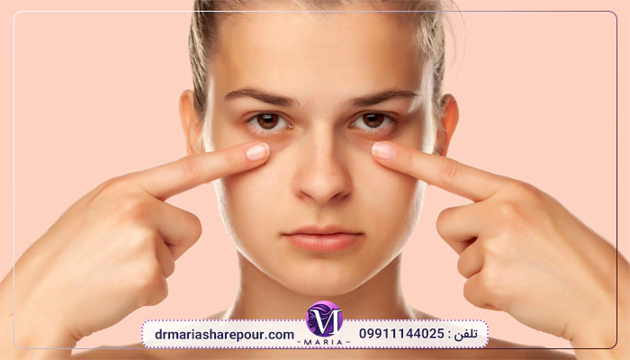 رفع تیرگی دور چشم با اگزوزم تراپی