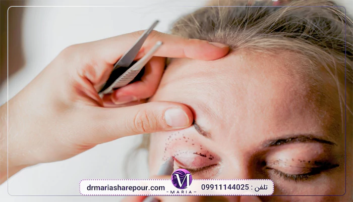 پتوز یا افتادگی پلک چیست؟