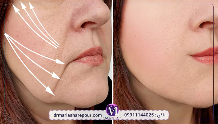 بهترین دکتر لیفت گونه کیست؟