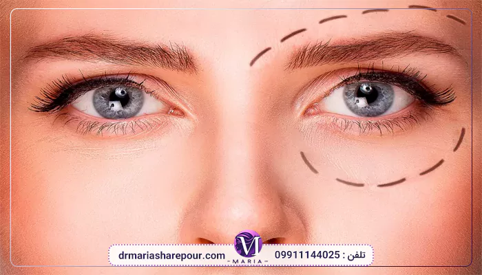 عوامل تاثیر گذار بر هزینه پتوز 